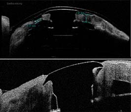 Corneal melt around Boston type I keratoprosthesis