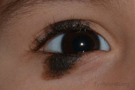 Kissing Nevus
