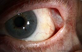Lacrimal gland dacryops