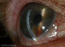 Lens material in the anterior chamber causing chronic uveitis