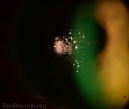 Lipid Deposits on Scleral Rigid Gas Permeable (RGP) Lens
