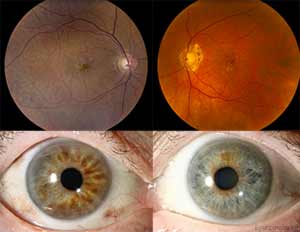 Ocular melanocytosis