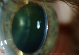 Metallic foreign body in corneal strima