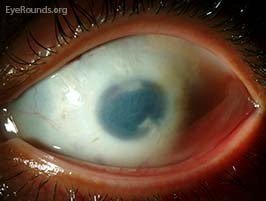 microcornea