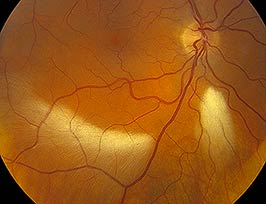 Myelinated nerve fiber layer with visual field defect