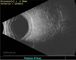 B-scan ultrasound of nanophthalmic eye