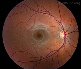 Normal fundus, child
