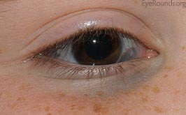 Oculodermal melanocytosis (nevus of Ota)