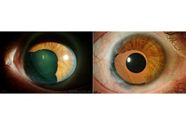 Ophtec 311 iris reconstruction intraocular lens after iris melanoma resection