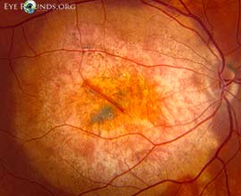 Choroidal osteoma