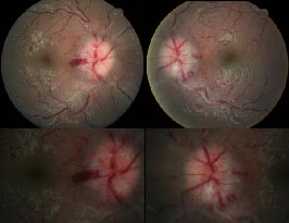 Papilledema secondary to meningitis