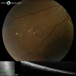 Grouped congenital albinotic spots of the retinal pigmented epithelium (polar bear tracks)