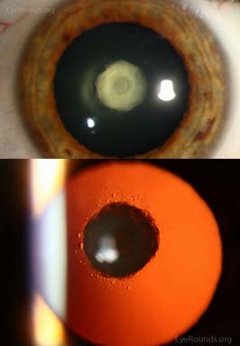 Posterior Polar Cataract