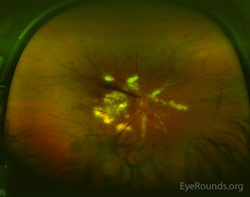Severe proliferative diabetic retinopathy