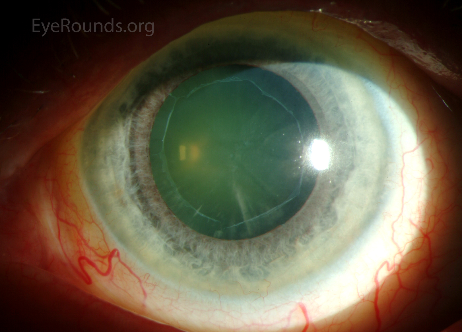 Exfoliative material on the pupillary margin and anterior lens capsule