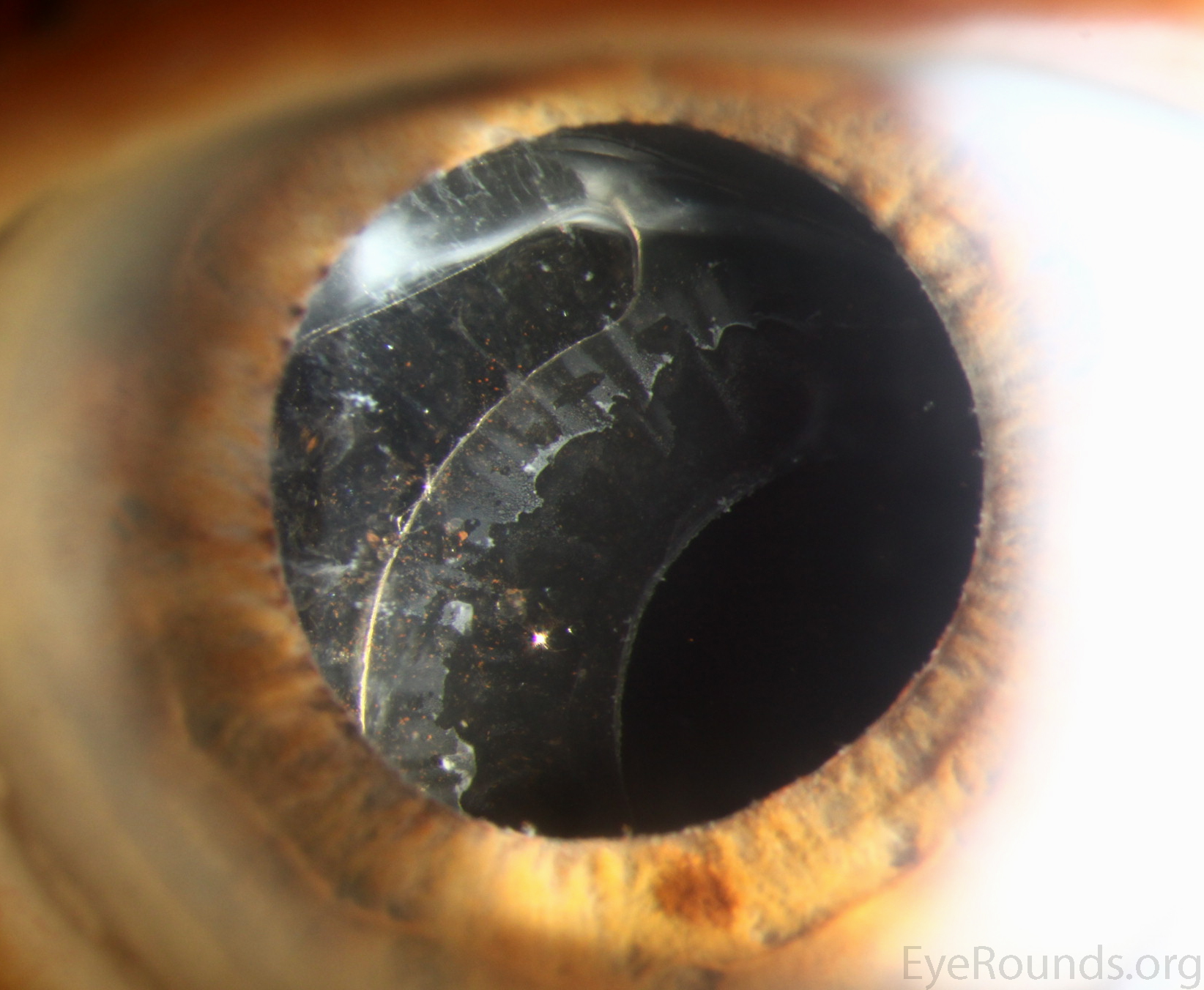 Subluxated intraocular lens implant occurring spontaneously many years after cataract surgery