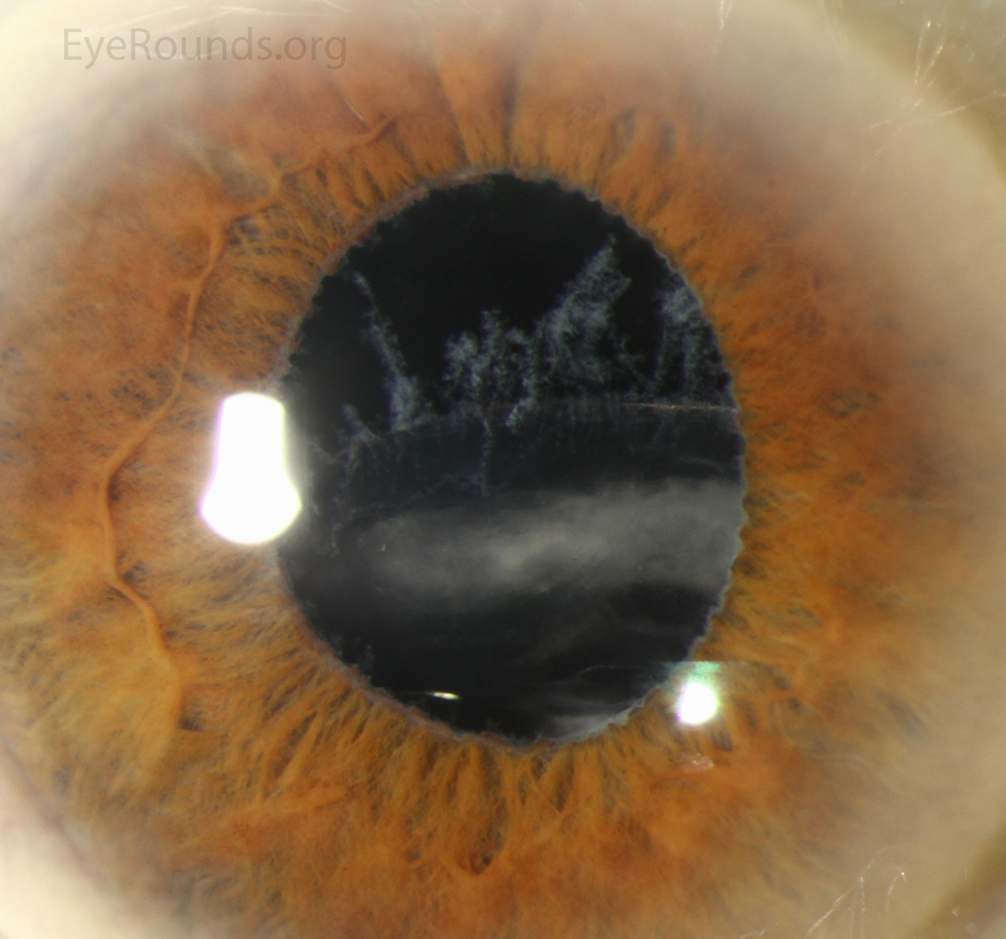 Inferiorly displaced posterior chamber intraocular lens located in the capsular bag