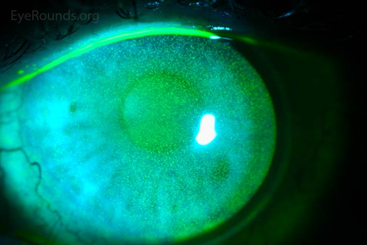 Punctate epithelial erosions (PEE)