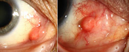 Pyogenic granuloma