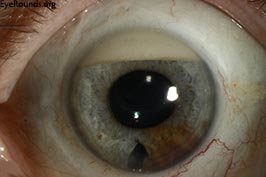 Reverse hypopyon