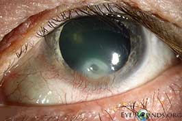 Corneal ulcer secondary to ocular rosacea