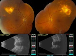 Sclerochoroidal calcification