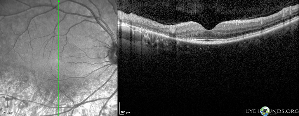 Sectoral retinitis pigmentosa (RP) OCT OD