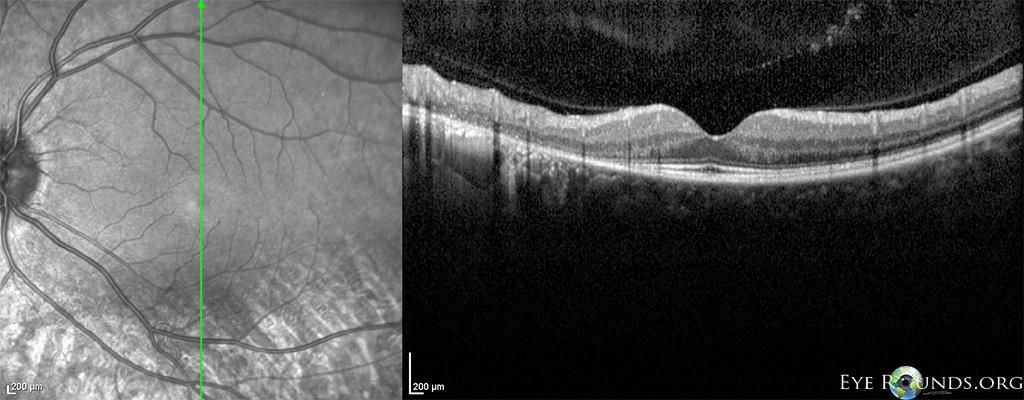 Sectoral retinitis pigmentosa (RP) OCT os