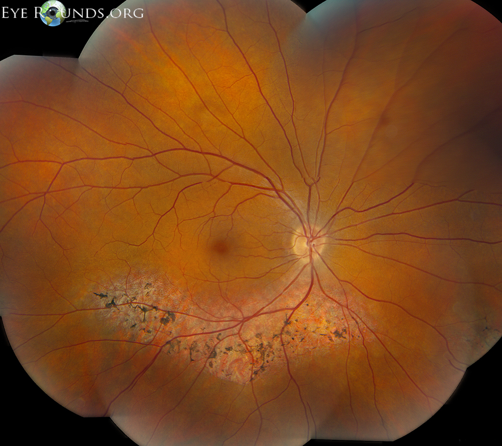 Sectoral retinitis pigmentosa (RP) montage od
