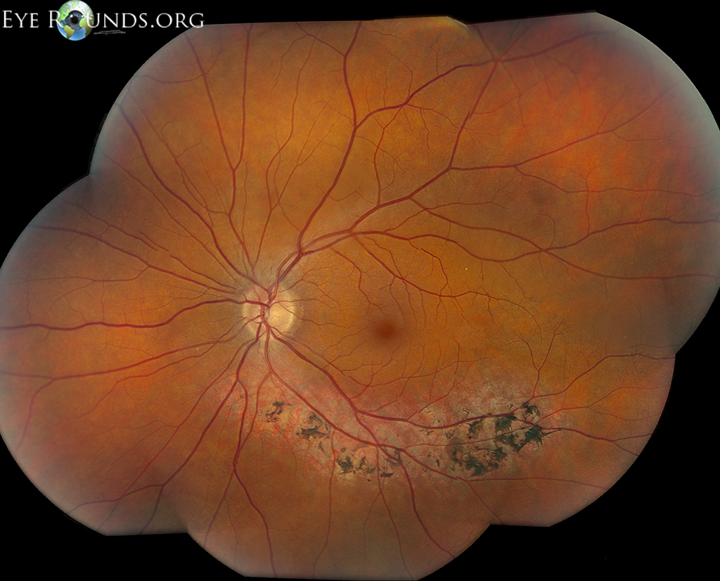 Sectoral retinitis pigmentosa (RP) montage os