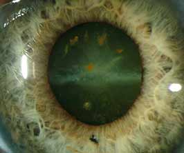 Siderosis bulbi