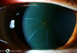 Stellate corneal epithelial iron line after radial keratotomy