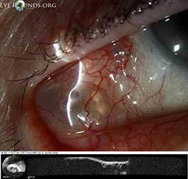 Subconjunctival silicone oil