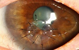 Tectonic mini-penetrating keratoplasty (PKP)