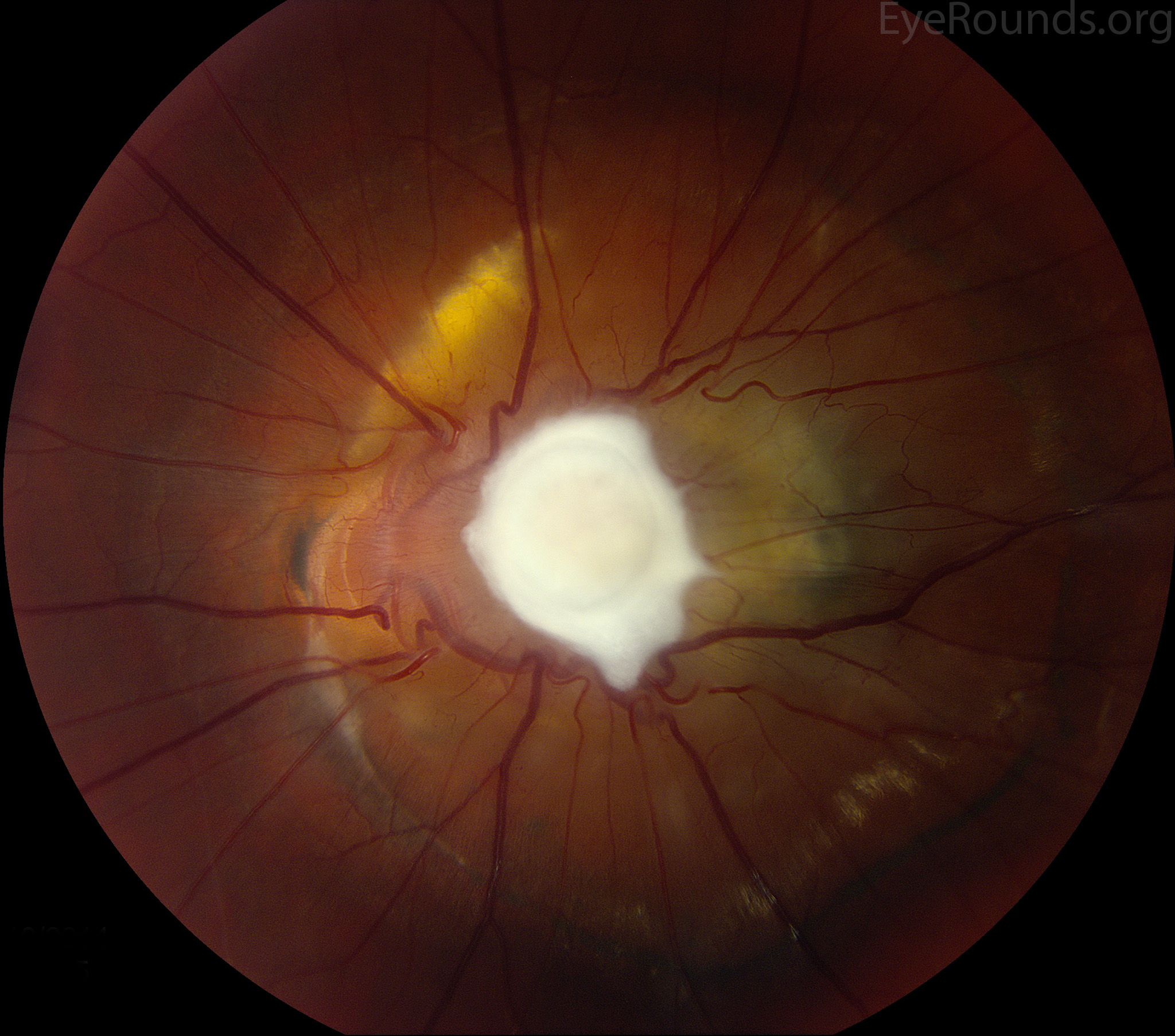 localized granuloma located over the optic nerve
