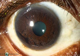 Traumatic endothelial pigment deposition