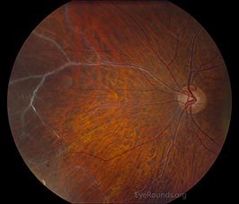 Vascular sheathing in idiopathic retinal vasculitis