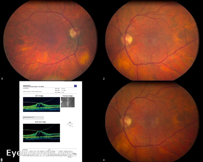 3 fundus photos and an OCT showing Vitreoretinal traction with associated macular edema