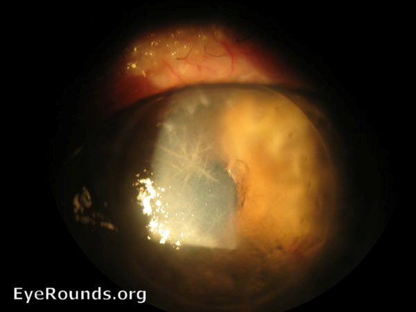 Infectious crystalline keratopathy in corneal transplant graft
