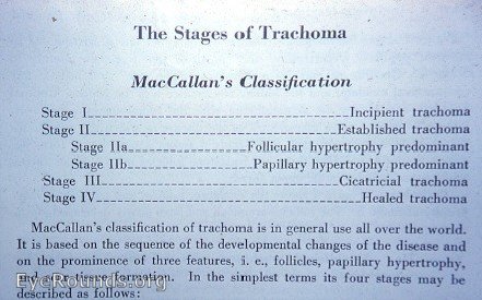 MacCallan's classification of trachoma
