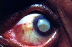Hypermature Morgagnian Cataract with pathognomonic white dots beneath the anterior capsule
