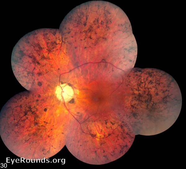 montage color fundus photograph of the left eye in a patient with autosomal recessive RP