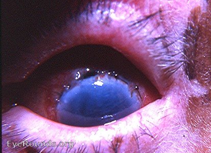 post-op cataract complications