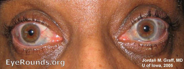 both eyes showing thinning of the sclera