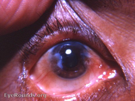 pterygium - temporal and nasal pterygia in an eye