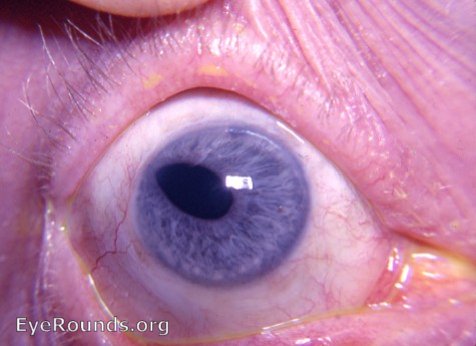 corectopia : eccentricity of the pupil