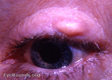internal sty: also called abscess of meibomian gland or subacute meibomianitis ( meibomitis )