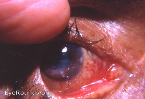 keratitis: keratitis e lagophthalmos with lateral tarsorraphy