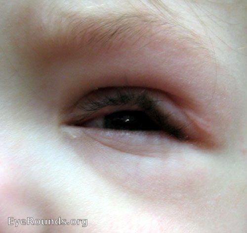 external face image showing Neurofibroma (NF) in the lid causing a s-shaped ptosis.
