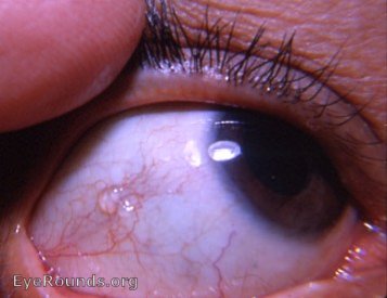 small white spot on pupil of eye